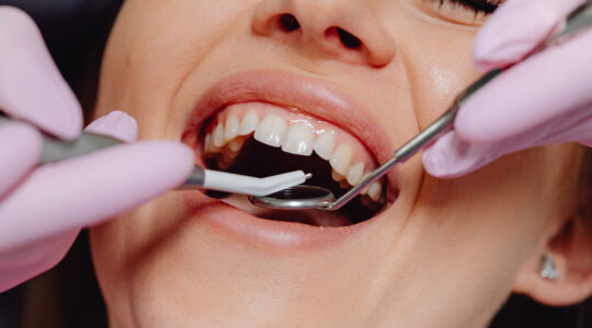 déchaussement dentaire